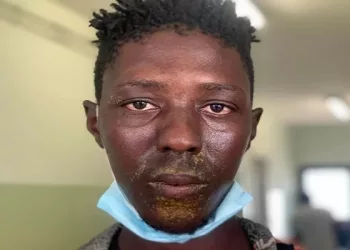 Guinée : des pêcheurs  victimes de brûlures  chimiques au niveau du visage et des organes génitaux