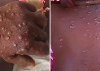 Alerte sanitaire : 9 cas suspects de variole du singe signalés en Guinée