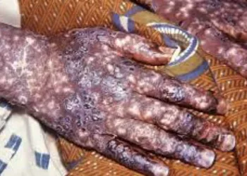 Tout savoir sur la variole de singe : causes, symptômes, transmission, personnes à risque et traitement