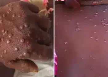 Guinée : l’ANSS annonce un premier cas de Mpox dans le pays
