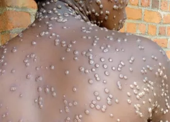 Guinée : guérison du premier cas de variole du singe confirmée par l’ANSS