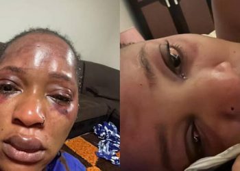 Ecchymoses autour des yeux, lèvres tuméfiées : des images choc de Djelykaba Bintou