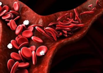 Drépanocytose : un Guinéen sur dix potentiellement concerné