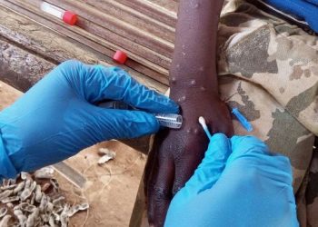 Mpox en Guinée : 112 cas confirmés, 26 patients guéris,  selon l’ANSS