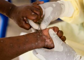 Mpox en Guinée : près de 100 nouveaux cas enregistrés en une semaine